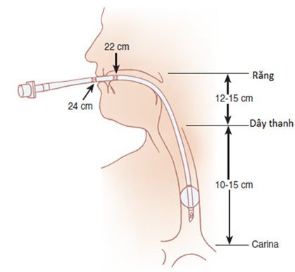 Khuyến nghị khi đặt nội khí quản cho bệnh nhân COVID-19