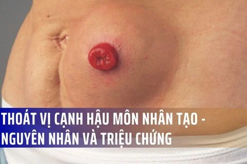 Nguyên nhân và nguy cơ xảy ra thoát vị cạnh hậu môn nhân tạo