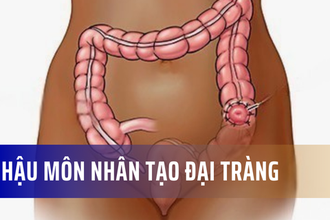 Hậu môn nhân tạo đại tràng là gì?