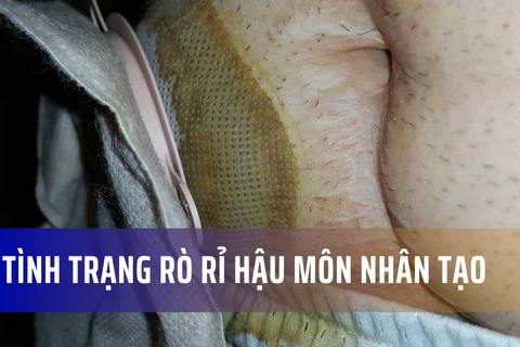 Rò rỉ hậu môn nhân tạo: Tình trạng chung và Biểu hiện