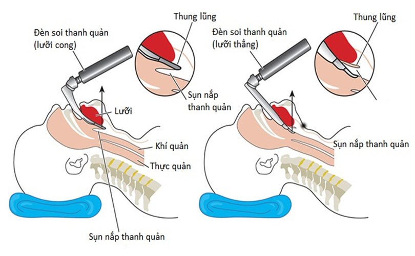 Đặt lại ống nội khí quản và nguy cơ viêm phổi liên quan đến máy thở ở bệnh nhân