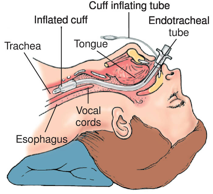 Những tiến bộ công nghệ trong ống nội khí quản để ngăn ngừa bệnh viêm phổi VAP