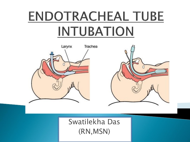 Tiến bộ công nghệ trong ống nội khí quản ngăn ngừa sự thoát dịch rỉ