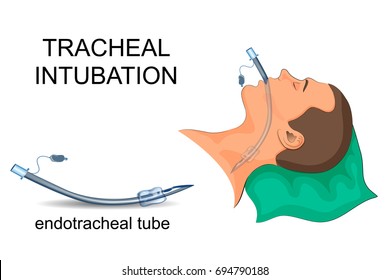 Tiến bộ công nghệ trong ống nội khí quản Ngăn ngừa sự hình thành màng sinh học