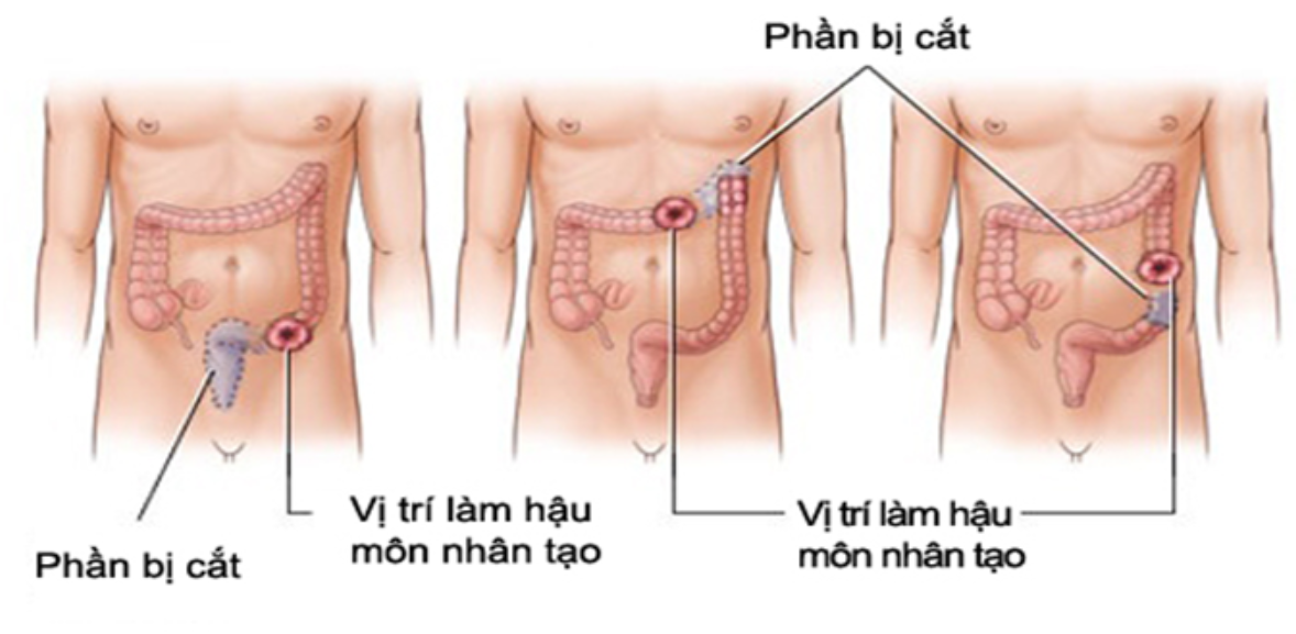 Đặc điểm Đế bằng HẬU MÔN NHÂN TẠO có viền băng keo