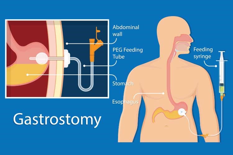 Chăm sóc bệnh nhân có ống nuôi ăn đường ruột