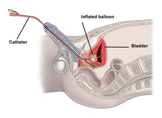 Dẫn lưu nước tiểu 