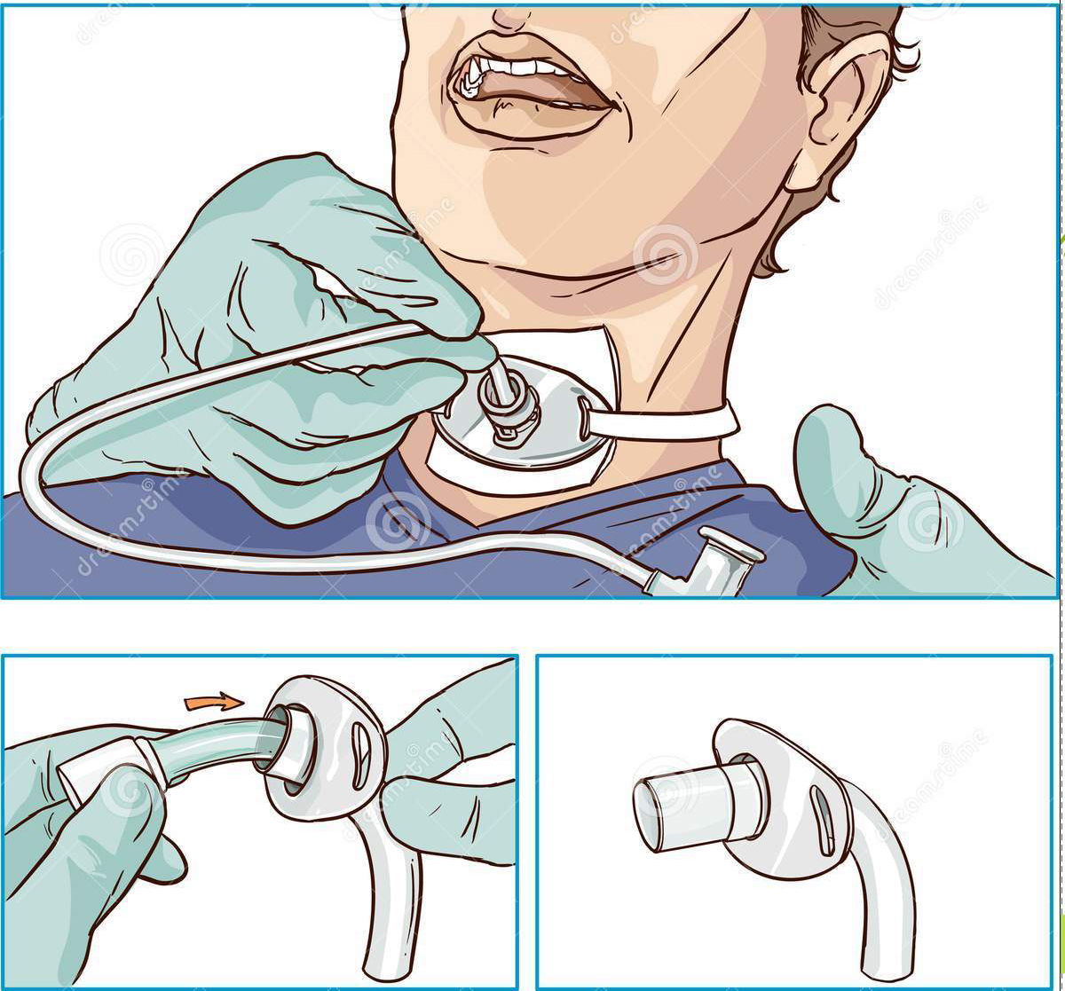 Thay ống mở khí quản phần 2