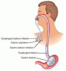 Ống chẹn thực quản, dạ dày SENGSTAKEN-BLAKEMORE TUBE 