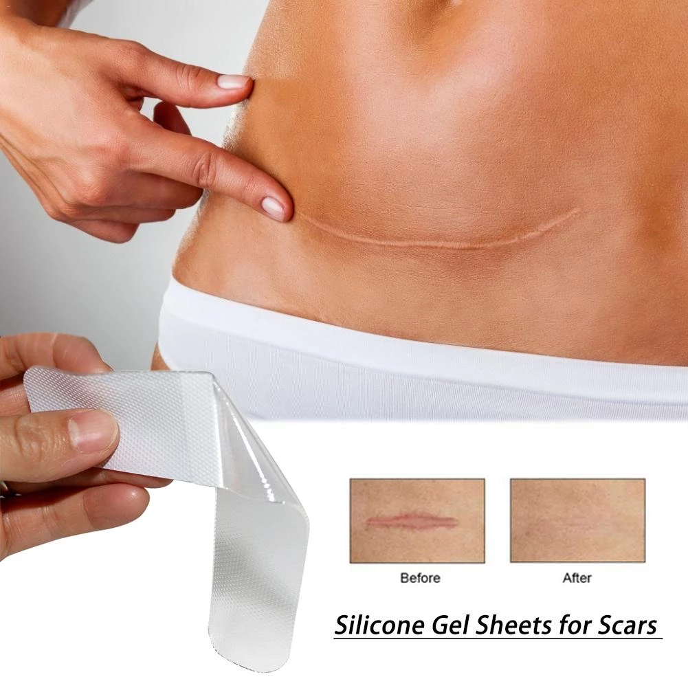Miếng dán silicon ép sẹo - bước tiến mới trong điều trị sẹo