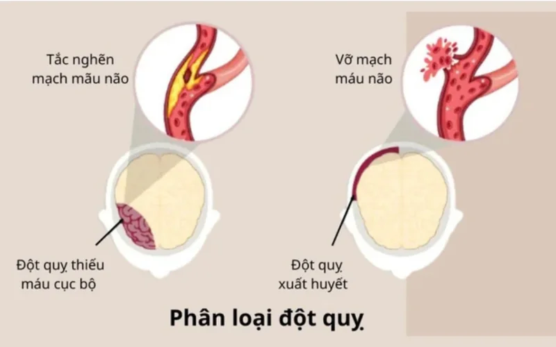 Phân loại Đột quỵ