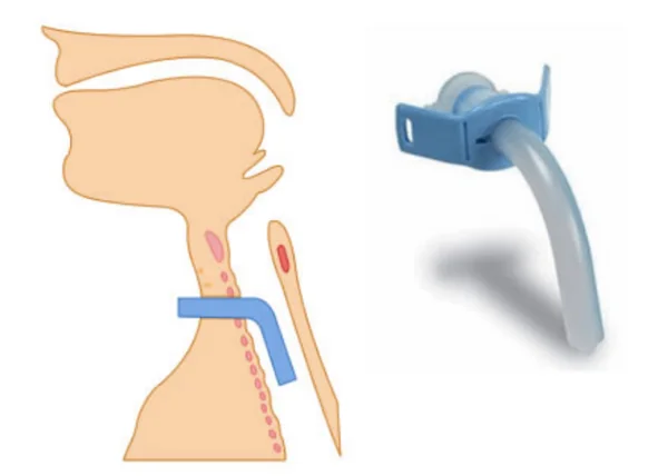 ống mở khí quản không có bóng