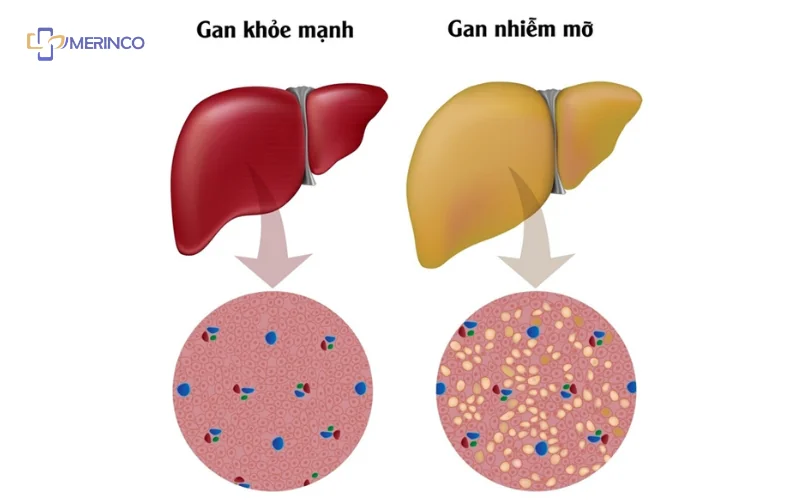 gan nhiễm mỡ