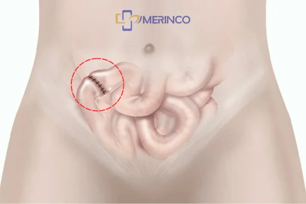 Khi nào người bệnh được đóng hậu môn nhân tạo?
