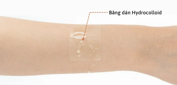 Băng dán Hydrocolloid - Trị bỏng tại nhà an toàn