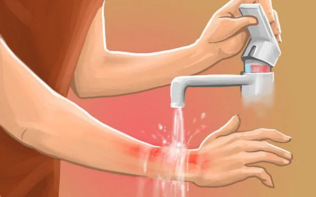 8 cách xử trí bỏng để ngăn ngừa sẹo 8 cách xử trí bỏng để ngăn ngừa sẹo