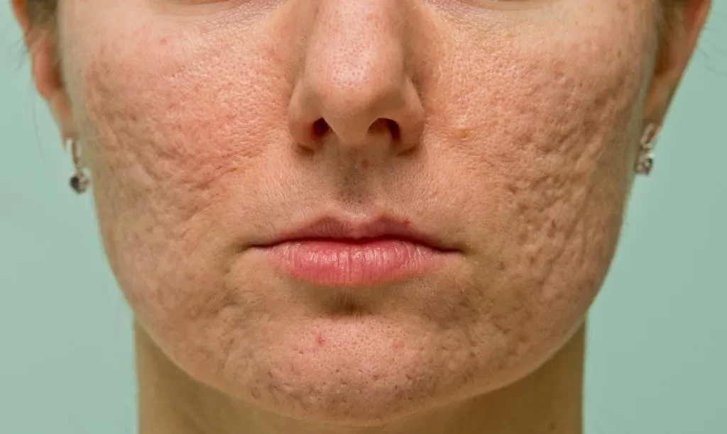 Rolling Acne Scars; Causes And Solutions | Trusted Aesthetic Clinic