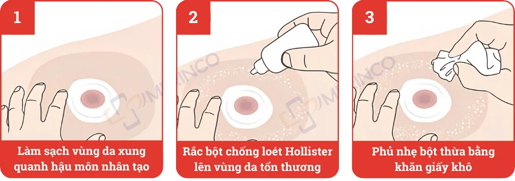 Bột hút ẩm chống loét hậu môn nhân tạo Hollister Adapt Stoma Power 7906