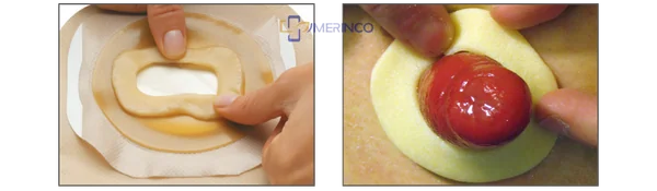 Kem chống xì và vòng chống loét dành cho hậu môn nhân tạo