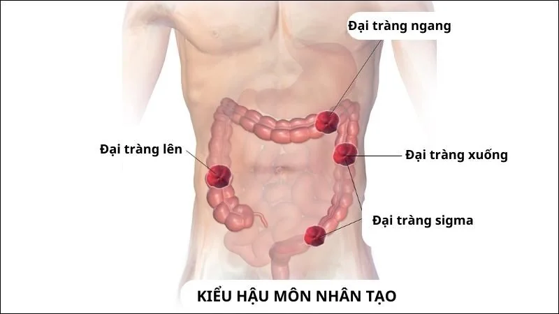 các vị trí hậu môn nhân tạo