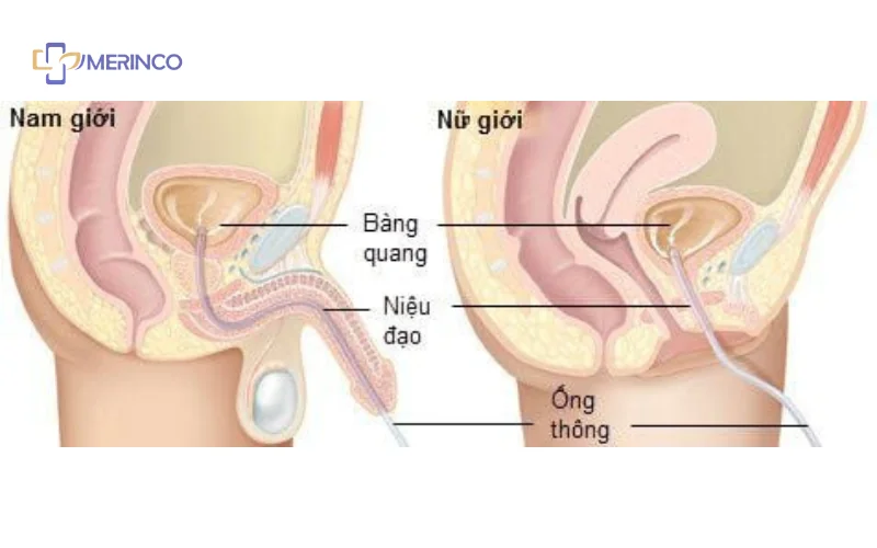 ống thông tiểu