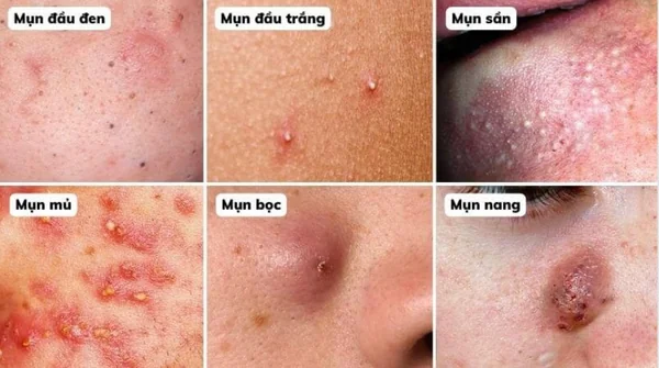 Các loại mụn trứng cá