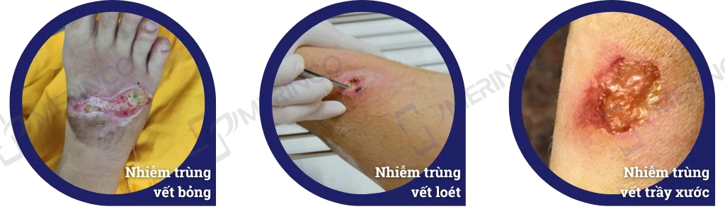 Băng gạc xốp tẩm bạc kháng khuẩn Therasorb® Ag Plus siêu thấm hút không dính vào vết thương 10cmx10cm