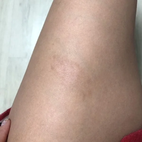 Quá trình cải thiện sẹo khi sử dụng miếng dán ép sẹo RemScar TR