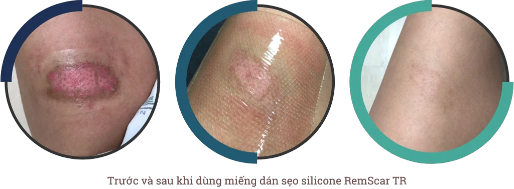 Sẹo bỏng sử dụng miếng dán sẹo RemScar TR