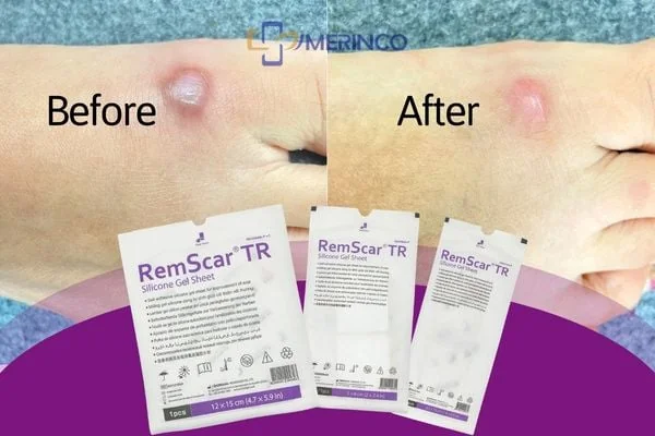 Miếng dán silicon trị sẹo RemScar TR: Đột phá mới của công nghệ trị sẹo