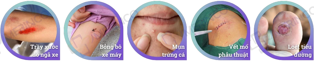 Băng dán vết thương DuoDerm Extra Thin 10cmx10cm - Miếng dán mụn hydrocolloid