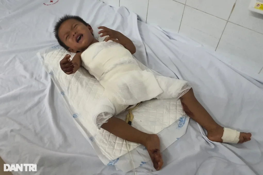 Lặng người trước bé 2 tuổi bị bỏng nặng vì ngã vào nồi cám lợn - 2 Lặng người trước bé 2 tuổi bị bỏng nặng vì ngã vào nồi cám lợn - 2