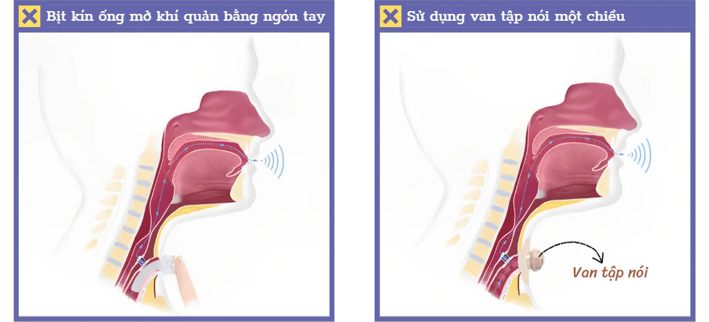 Mở khí quản có nói được không?