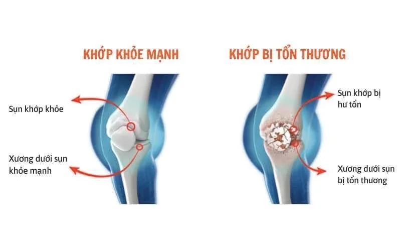 thoai-hoa-khop-goi