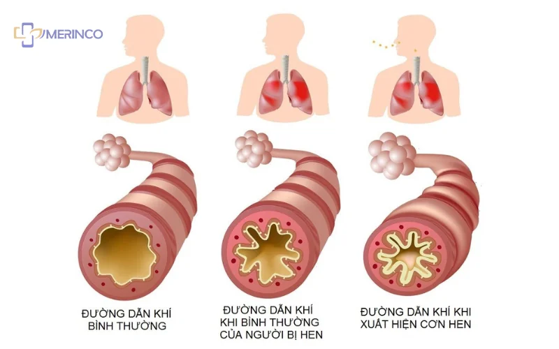 Hen suyễn là gì