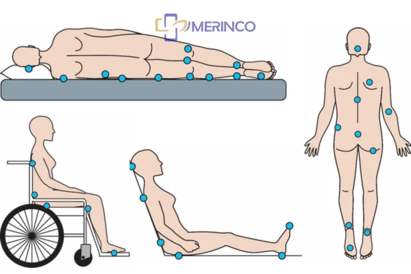 Nguyên nhân loét do tỳ đè và cách chăm sóc vết loét tại nhà