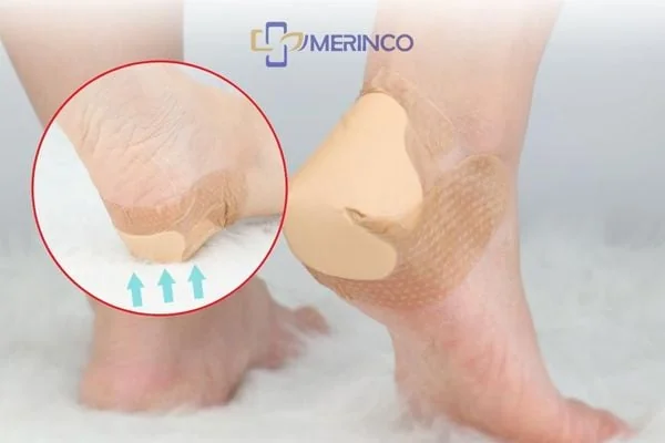 Tìm hiểu các loại loét da