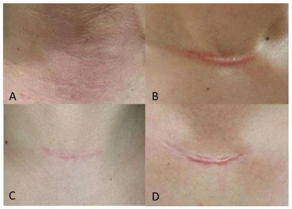 Cách trị sẹo sau mổ tuyến giáp