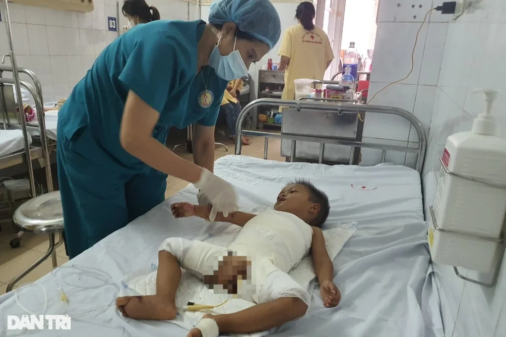 Lặng người trước bé 2 tuổi bị bỏng nặng vì ngã vào nồi cám lợn - 1 Lặng người trước bé 2 tuổi bị bỏng nặng vì ngã vào nồi cám lợn - 1