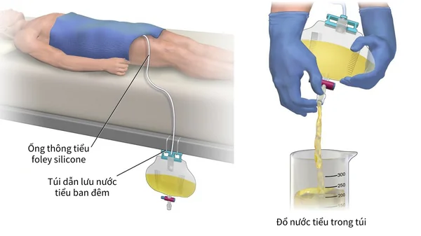 Những câu hỏi thường gặp khi sử dụng ống thông tiểu Foley