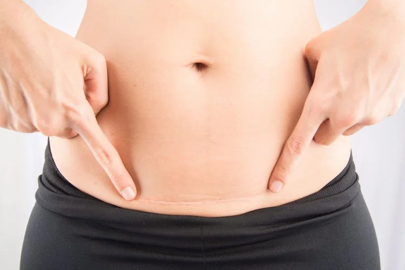 Sẹo sau mổ để có thể hình thành do cơ địa của sản phụ, đặc biệt là phụ nữ tuổi cao