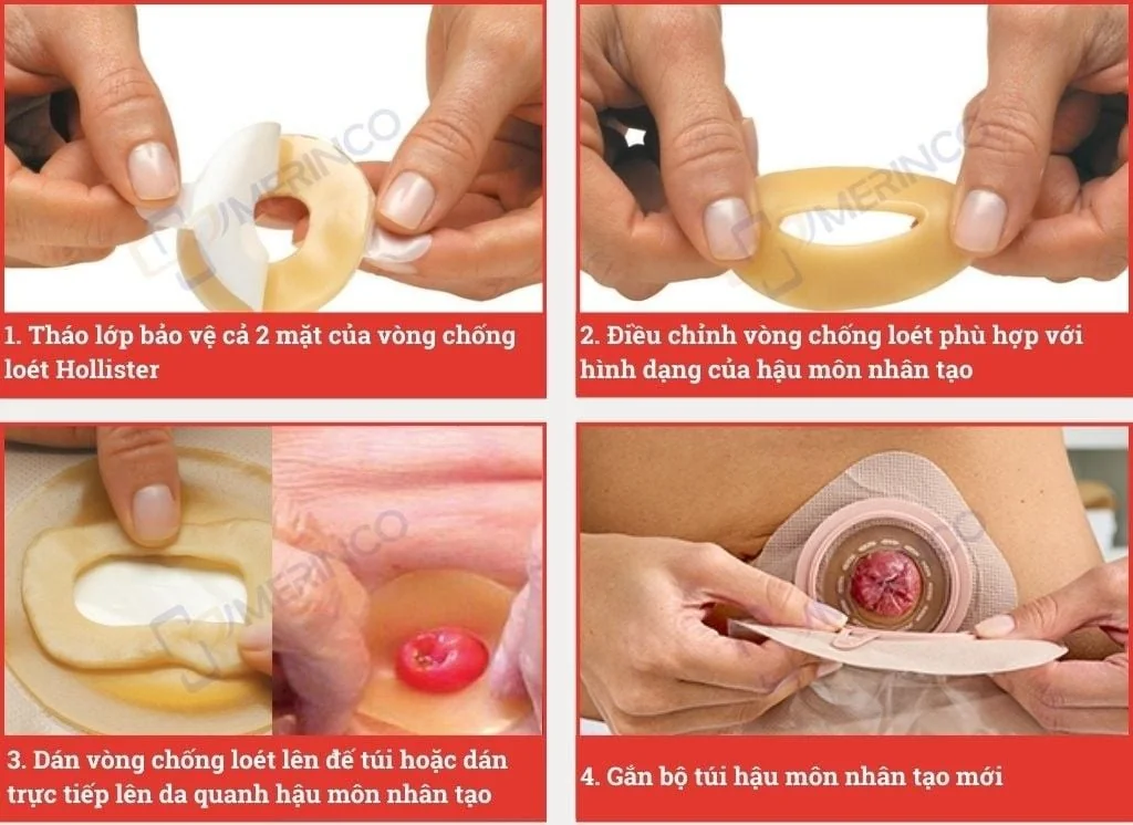 Vòng bảo vệ da chống loét hậu môn nhân tạo Hollister