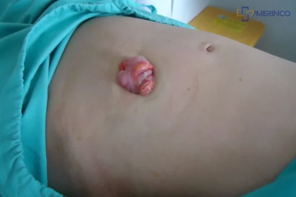 Thoát vị HMNT