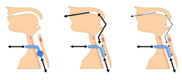 ống mở khí quản