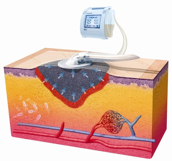 Liệu pháp chân không VAC - Hút áp lực âm