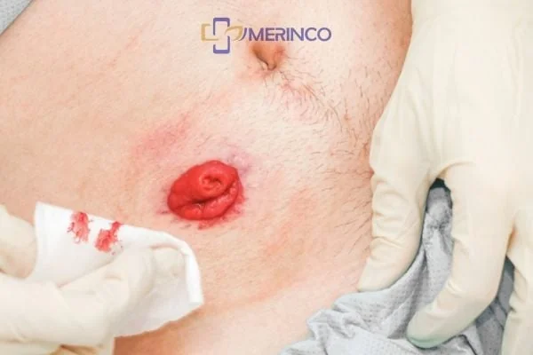 Biến chứng phổ biến của hậu môn nhân tạo: Vấn đề về da và rò rỉ