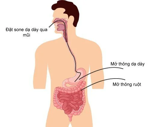 Ống thông mũi - dạ dày