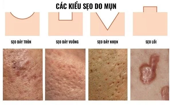 Các loại sẹo do mụn gây ra