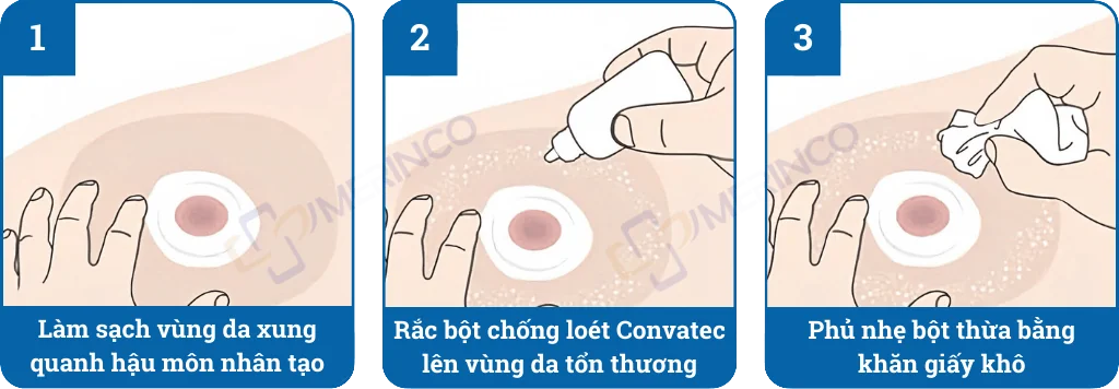 Bột hút ẩm chống loét ConvaTec bảo vệ da quanh hậu môn nhân tạo