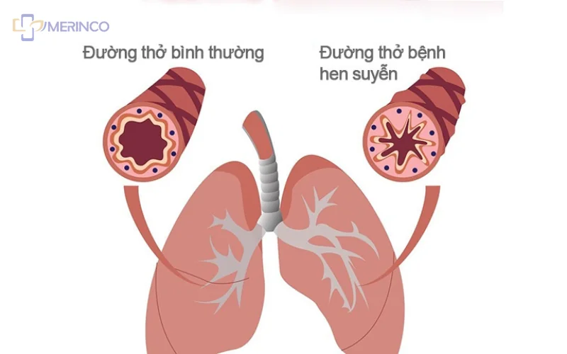bệnh hen suyễn